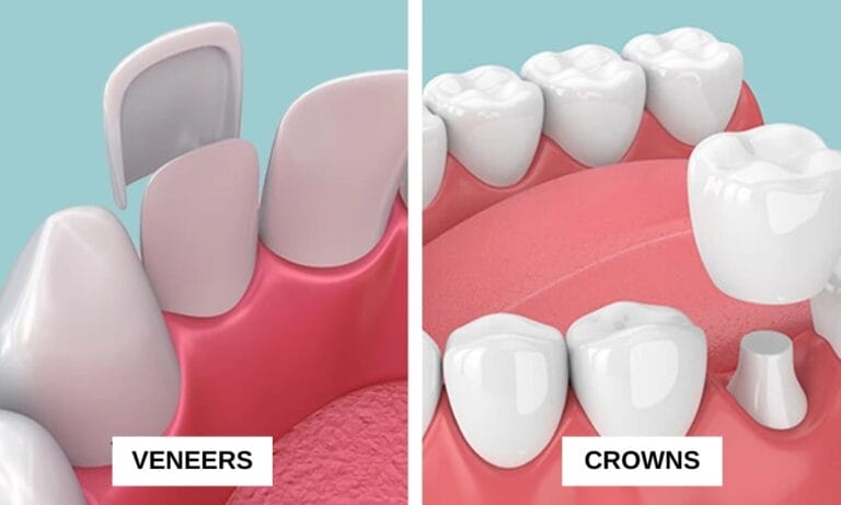 Avery Dental Wellness - Dental Crowns Vs. Veneers