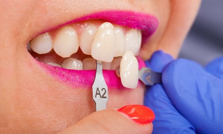 Do We Need Wisdom Teeth Removed Before Getting Porcelain Veneers - Avery Dental Wellness
