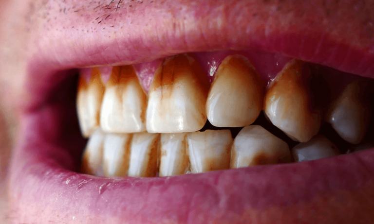 How To Remove Coffee Stains From Teeth Naturally