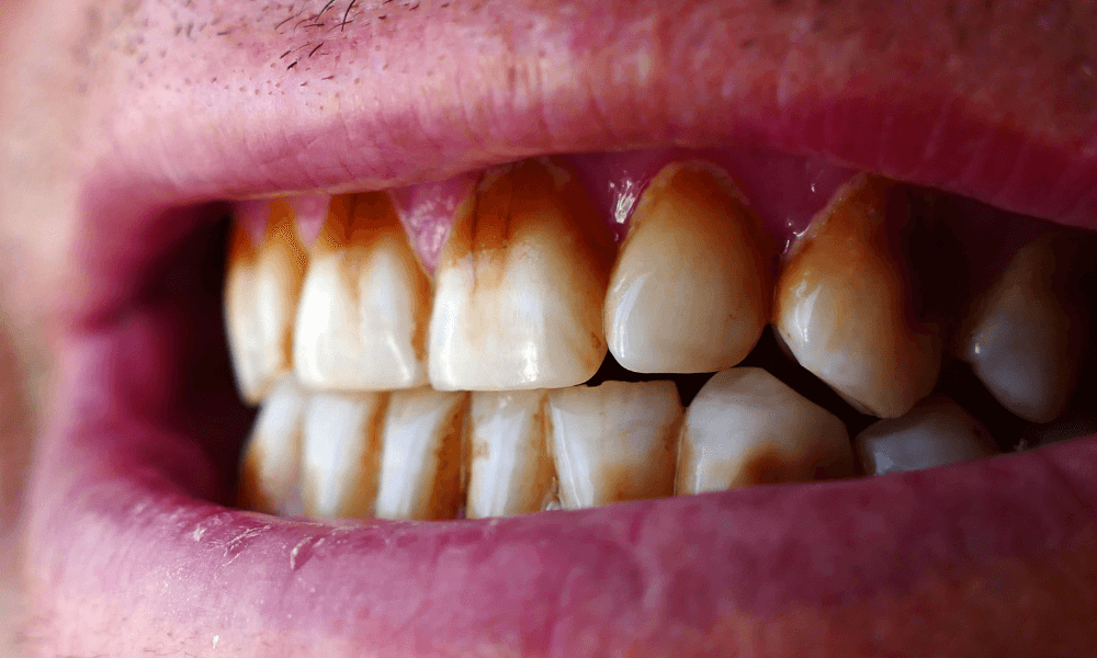 How To Remove Coffee Stains From Teeth Naturally