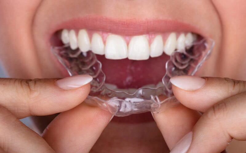 How to Take Care of Clear Aligners