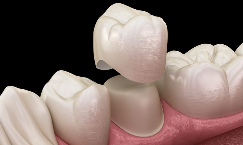 five signs you might need a dental crown