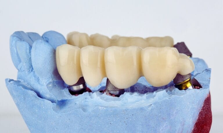 how to maintain dental bridges