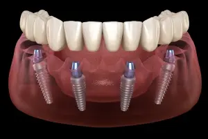 All-on-4 dental implants model showing prosthetic teeth on implant posts in Dublin.