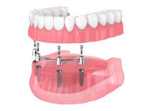 Illustration of a full arch dental implant restoration