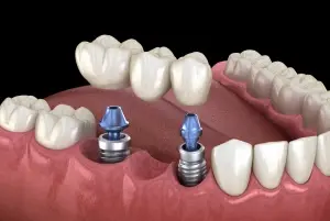 Implant-supported bridge illustration showing dental implants and prosthetic teeth.