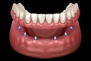 Implant-supported denture model showing dental implants anchoring a full upper arch prosthetic.