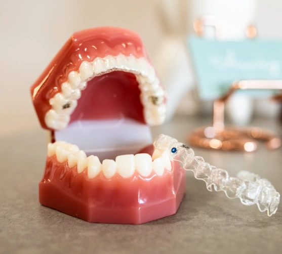 Clear aligner next to a dental model used for orthodontic treatment