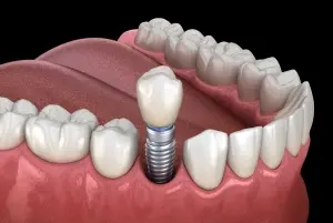Single dental implant with crown positioned between natural teeth in Dublin.