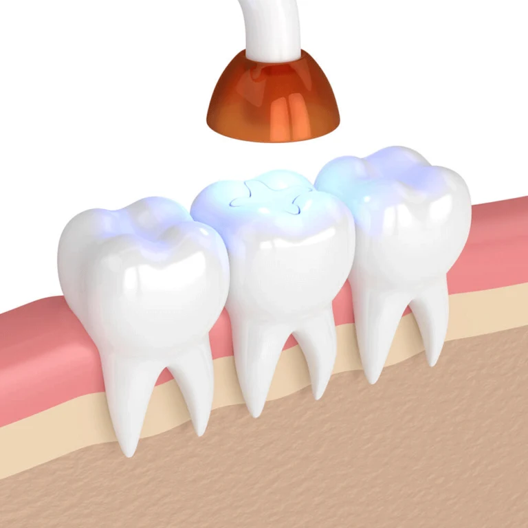 Dental curing light hardening a tooth filling restoration