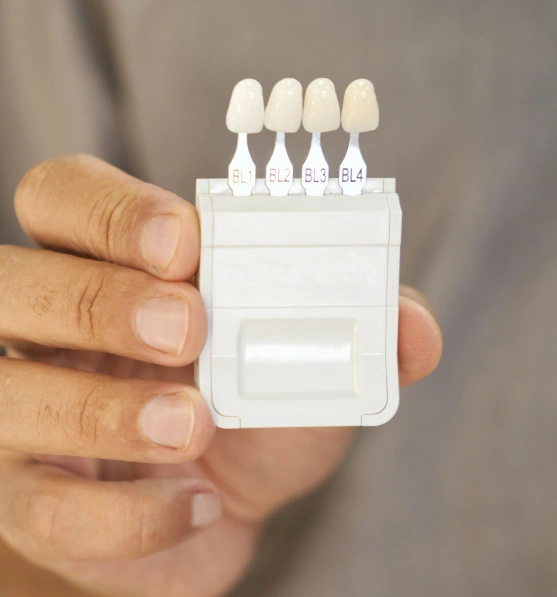 Shade guide used for selecting custom dental veneers