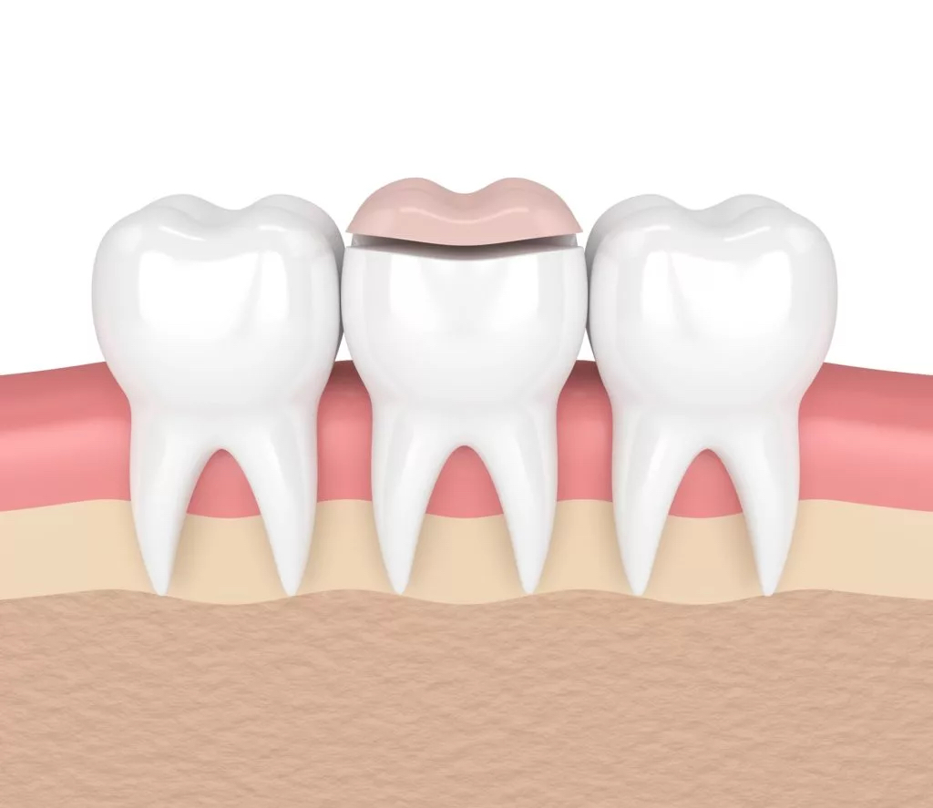 Dental Inlays and Onlays