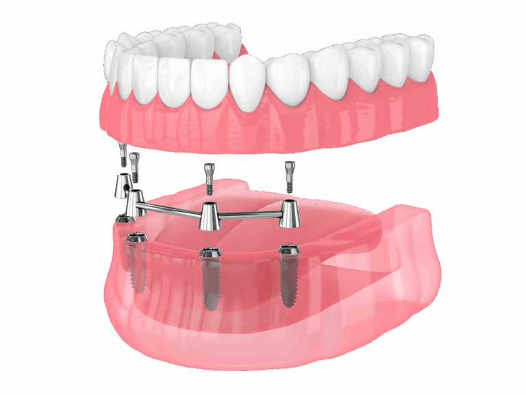 All-on-4 Dental Implants at Avery Dental Wellness in Dublin, OH