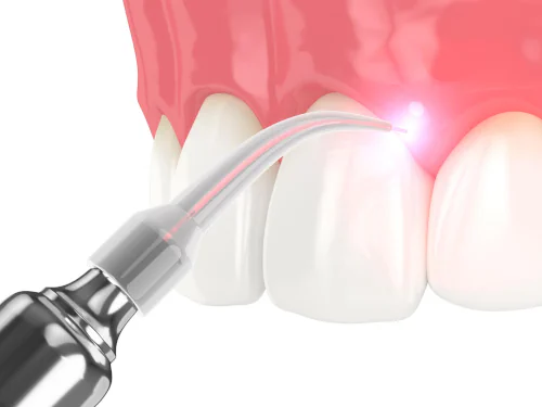 Soft Tissue Dental Laser in Dublin, OH, at Avery Dental Wellness