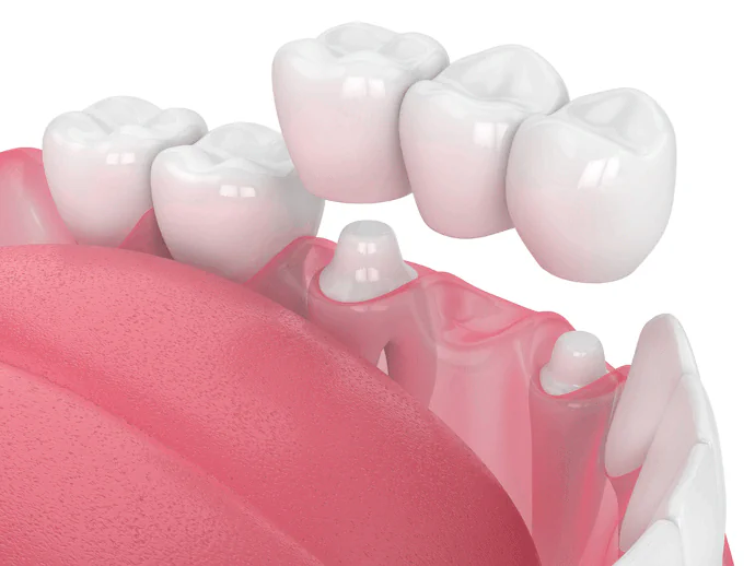 Dental Crowns and Bridges